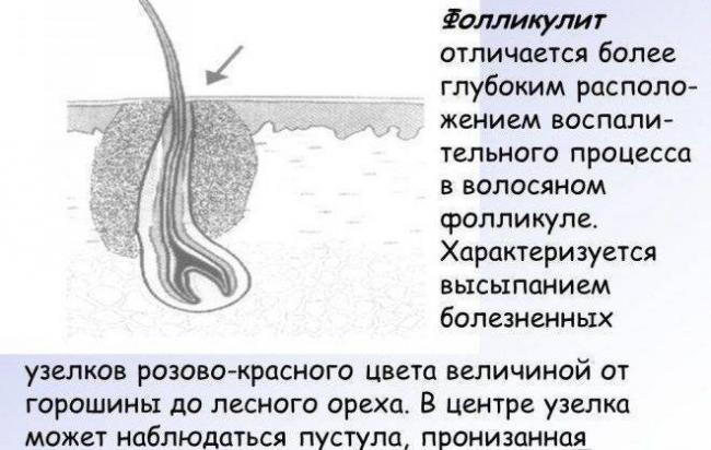 Malassezia-фолликулит: клиника, диагностика, отличия от акне, лечение