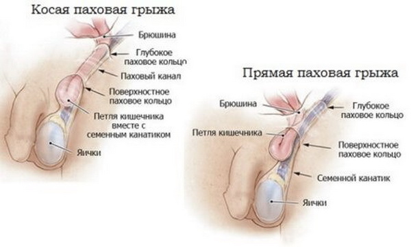 Лечение паховой грыжи в вопросах и ответах.