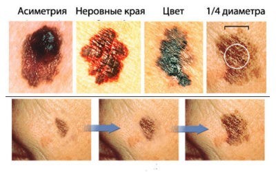 Родинки (невусы) – свойства, виды, причины появления, удаление, фото