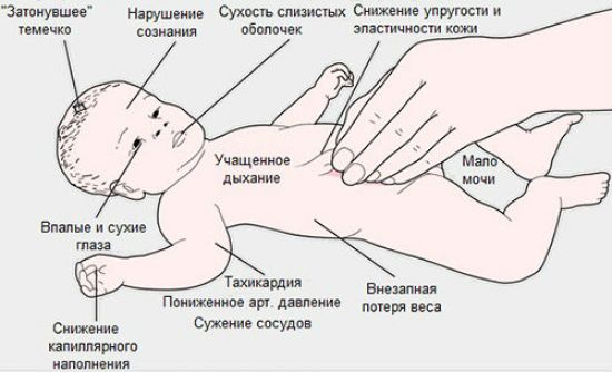 Врождённый адреногенитальный синдром - симптомы и лечение