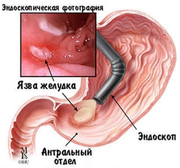 Язва желудка