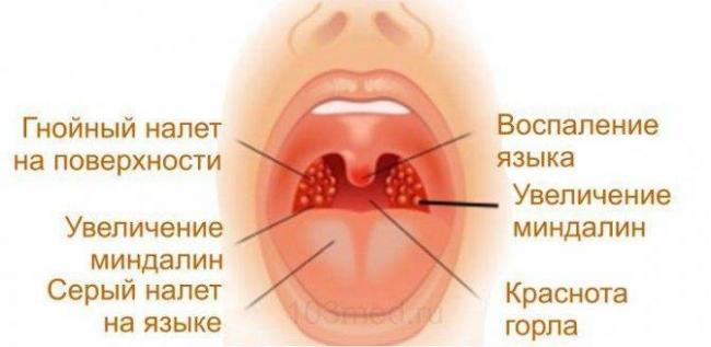 Ангина у взрослых — симптомы, лечение, профилактика