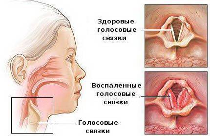 Как восстановить голос при ларингите у взрослых быстрое лечение