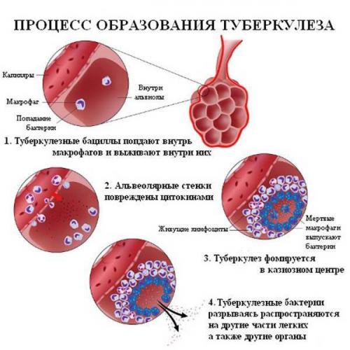 Чем отличается туберкулез от рака легких на снимках