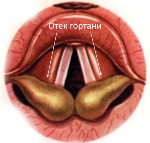Признаки аллергии на яблоки