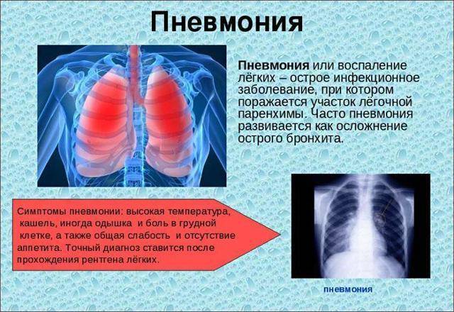 Дыхательная гимнастика при пневмонии: пример упражнений