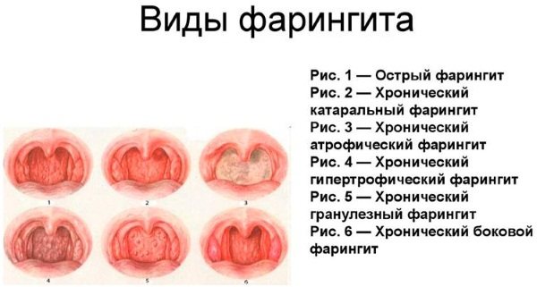 Фарингит у взрослых: симптомы, лечение, лекарства. как лечить хронический фарингит у взрослых