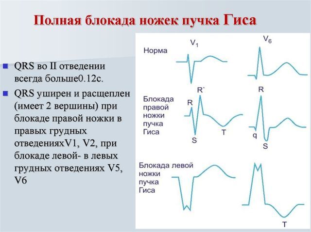 Неполная блокада пнпг на экг: не обращать внимание или обследоваться у кардиолога?
