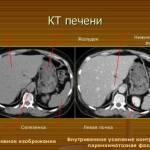 Компьютерная томография печени: подготовка и расшифровка