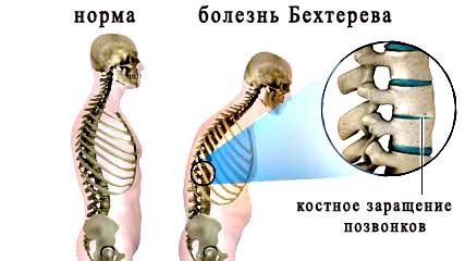Туберкулезный спондилит (болезнь потта): диагностика, симптоматика и лечение
