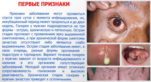 Гонорея