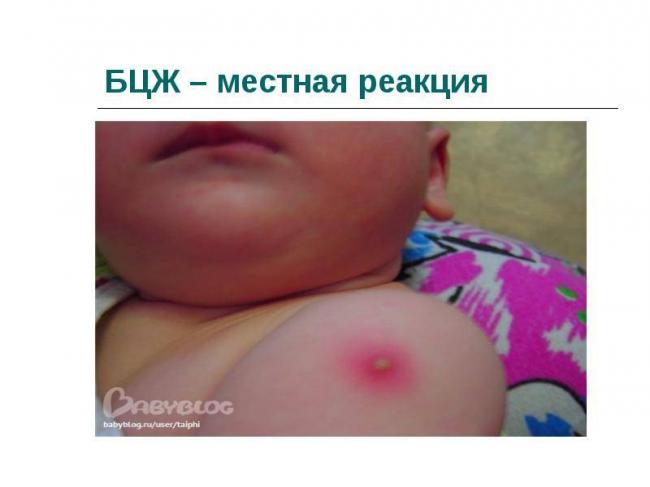 Оценка результата пробы манту у детей: на какой день и как проверяют?