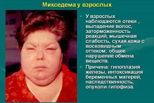 Гипотиреоз щитовидной железы — распространенная патология эндокринной системы