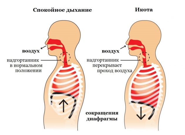 Икота – почему она возникает и как быстро от нее избавиться в домашних условиях? причины икоты у взрослых, у новорожденных после кормления, у беременной женщины и у плода. средства от икоты. как остановить после алкоголя?