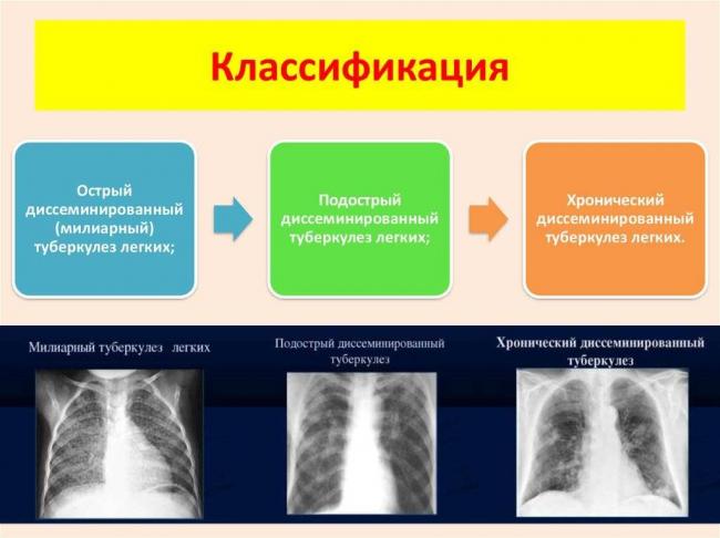 Диссеминированный туберкулез легких - дифференциальная диагностика