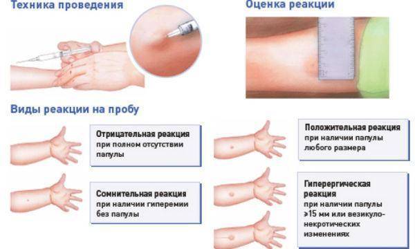Что такое диаскинтест и противопоказания делать детям