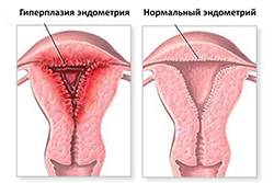 Хронический метроэндометрит: эндометрит, метроэндометрит, хронический метроэндометрит метроэндометрит хронический | метки: симптом, лечение