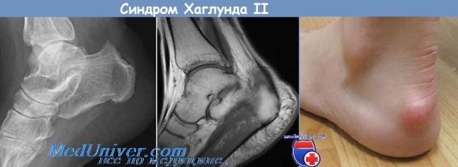 10 фактов о синдроме гийена-барре
