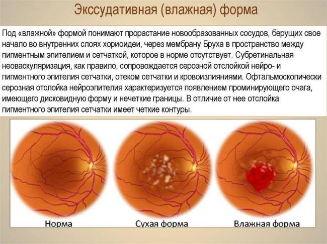 Центральная серозная хориоретинопатия: лечение, причины, симптомы, диагностика, прогноз, профилактика