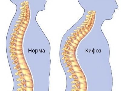 Лечение кифоза: упражнения, лфк при кифозе