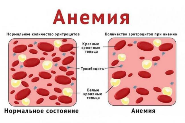 Проявления малокровия – причины и последствия дефицита железа