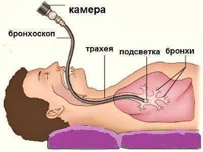 Щекочущий кашель: причины и особенности лечения