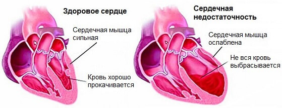 Предынфарктное состояние