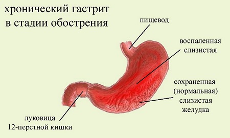 Диета при разных формах хронического гастрита желудка