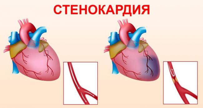 Что выбрать: мидокалм или калмирекс?