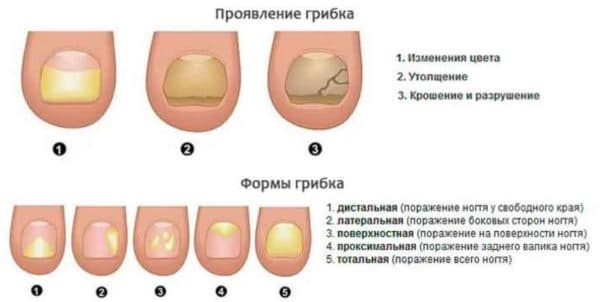 Дешевые аналоги экзодерила - список с ценами, что лучше помогает
