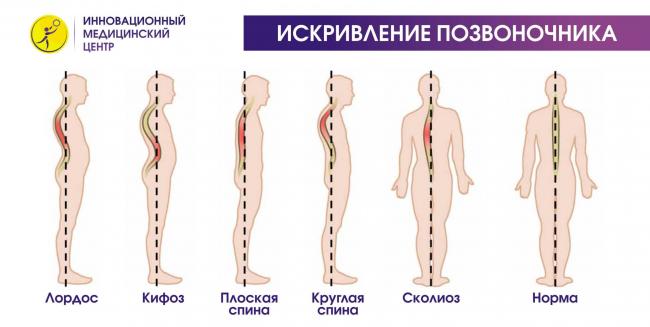 Выпрямление физиологического кифоза грудного отдела позвоночника