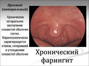 Сколько дней лечится гранулезный фарингит