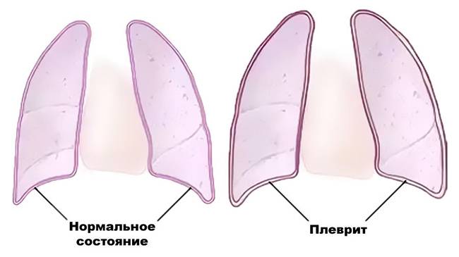 Кашель две недели и спина болит