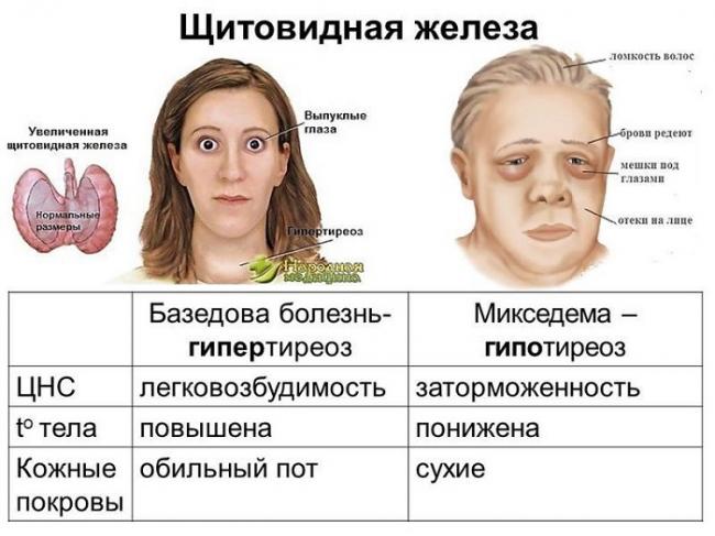 Гипотиреоз (микседема)
