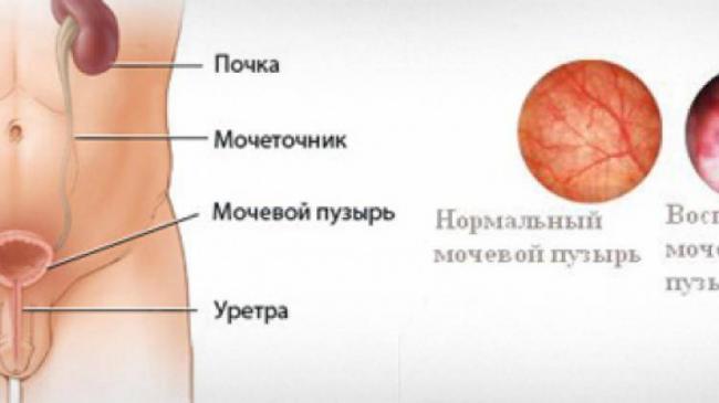 Описание препарата НИТРОКСОЛИН NITROXOLINE