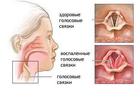 Как вылечить связки горла в домашних условиях — лор и простуда