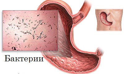 Гастроэнтерит: симптомы и лечение у взрослых