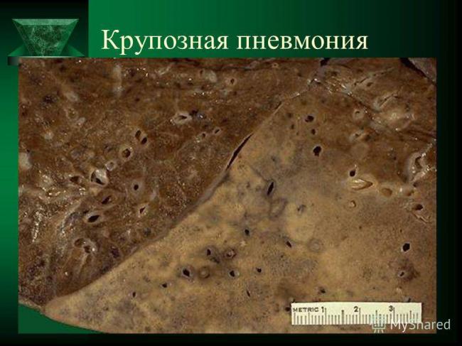 Крупозное воспаление легких: причины, симптомы, лечение