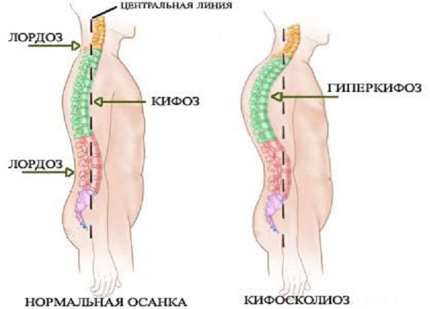 Как распознать и вылечить кифоз шейного отдела позвоночника?