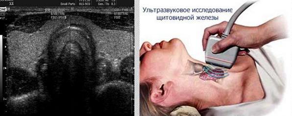 Неоднородная структура щитовидной железы: что это такое