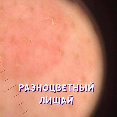 Избавиться от малассезии: лечение фолликулита и лишая