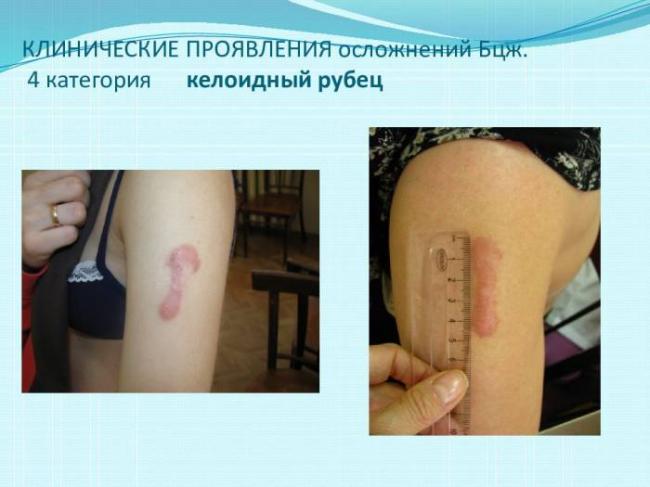 Нет рубца от бцж