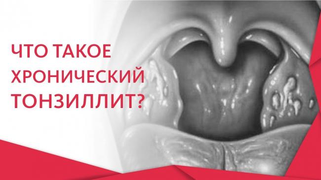 Лечение тонзиллита, как вылечить тонзиллит быстро и эффективно физеопроцедурами, симптомы болезни у взрослого без температуры