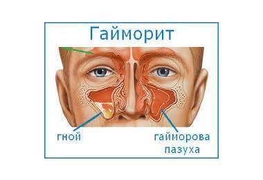 Антибиотики в лечении гайморита
