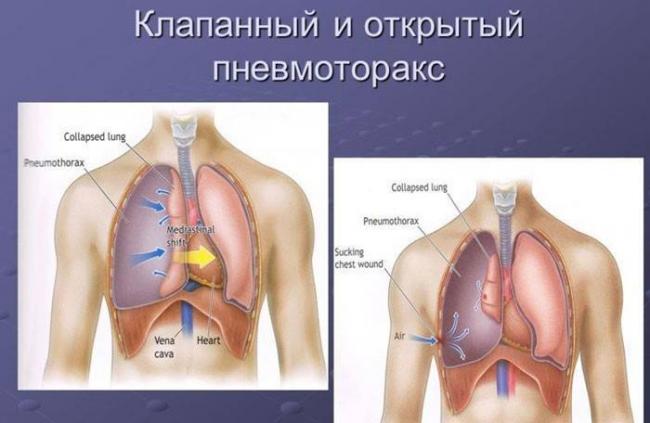 Можно ли вылечить туберкулез легких на ранней стадии