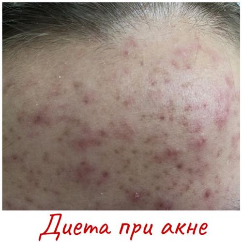 Лечебная диета при демодекозе лица с таблицей разрешенных и запрещенных продуктов питания