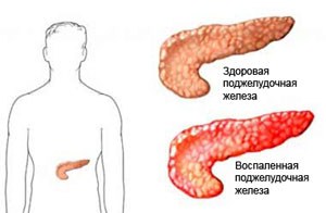 Питание при камнях поджелудочной железе