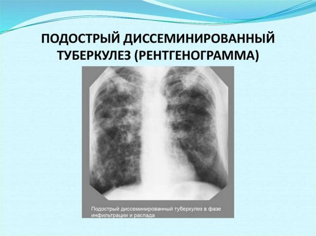 Дифференциальная диагностика туберкулеза легких