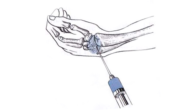 Кортизон (cortisone)