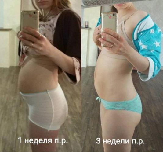 Как убрать живот после кесарева сечения - различные методы и средства + фото